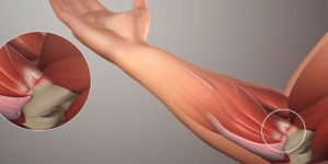 Vận Động Viên Tennis Gặp Chấn Thương