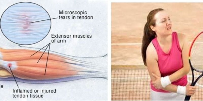 Vận Động Viên Tennis Gặp Chấn Thương